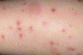 Insekter tåler ikke kulde under 15 grader og varme over 45 grader. På alle stadier af deres udvikling lever bugs af menneskeligt blod.